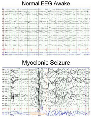 The seizure blog — Myoclonic seizures in adults are just one of the...