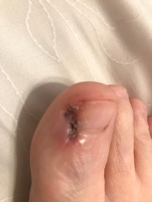 My newest pain…ingrown toenail surgery...