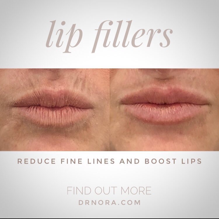 Not only do lips fillers make lips look fuller and hydrated but they also help to reduce fine lines around the mouth that can happen as we age.These lines are often called ‘smokers lines’ and although you may not be a smoker they occur due to the...