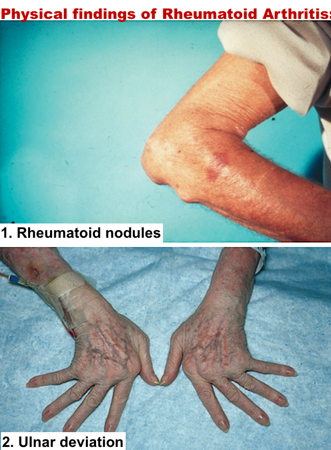 In Rheumatoid Arthritis Also Called Ra Atrophic Arthritis The Bodys Immune System Attacks 6771