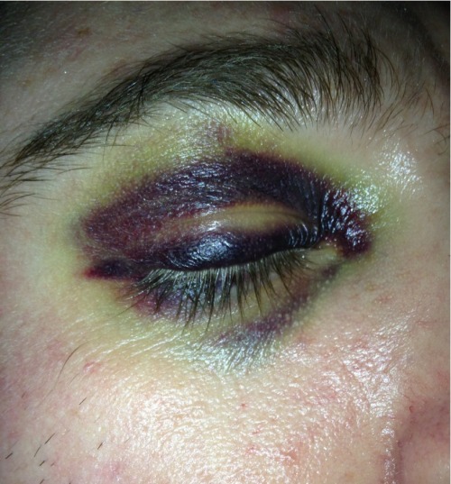 The black eye a few days later