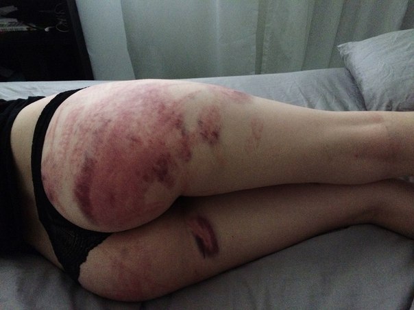 Picture Spanking Bruises Blog - Spanking Bruise Marks | BDSM Fetish