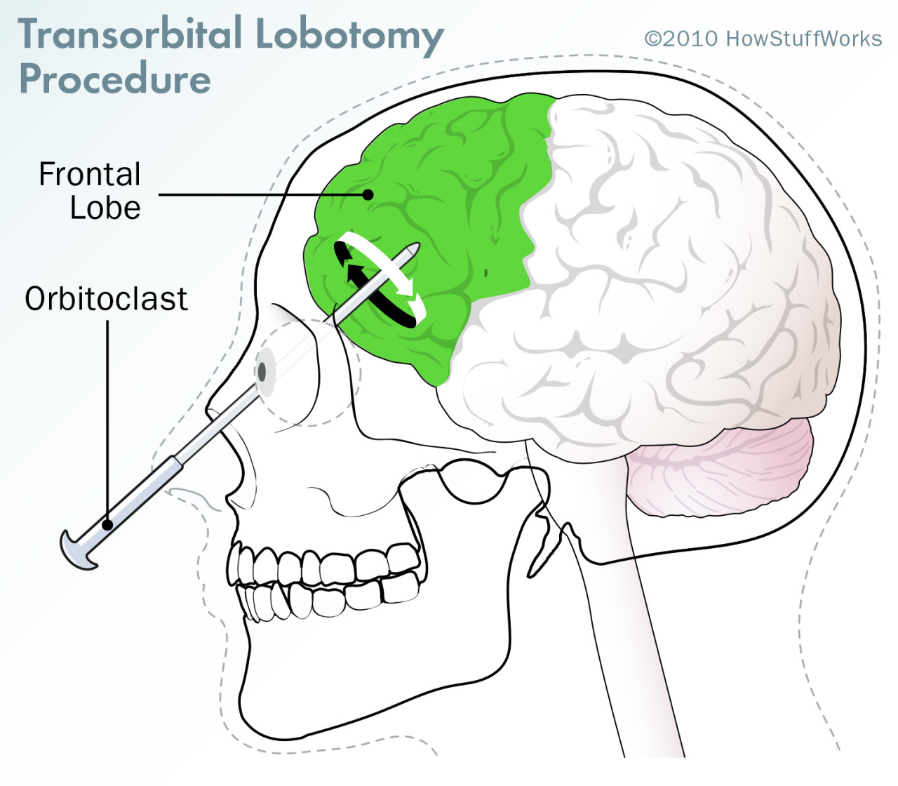 HowStuffWorks — How Lobotomies Work The lobotomy is a type of...