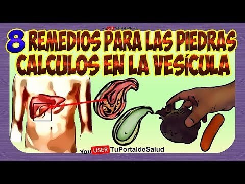 Dieta para polipos vesicula biliar english Dieta para polipos vesicula biliar english