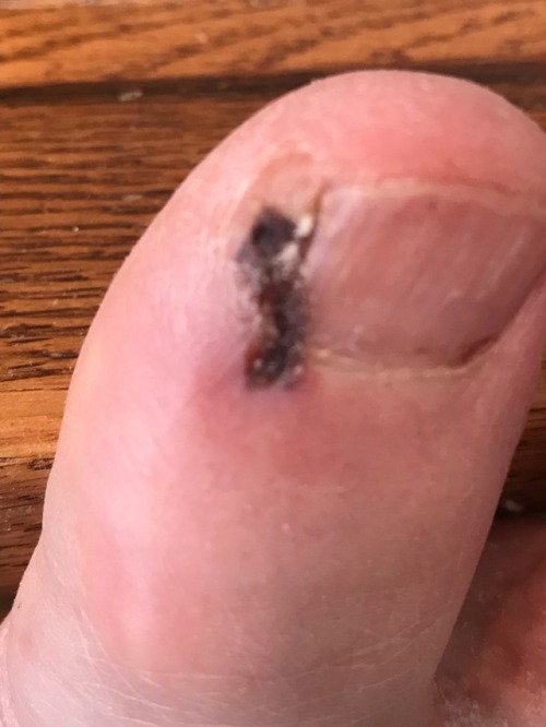 My newest pain…ingrown toenail surgery...