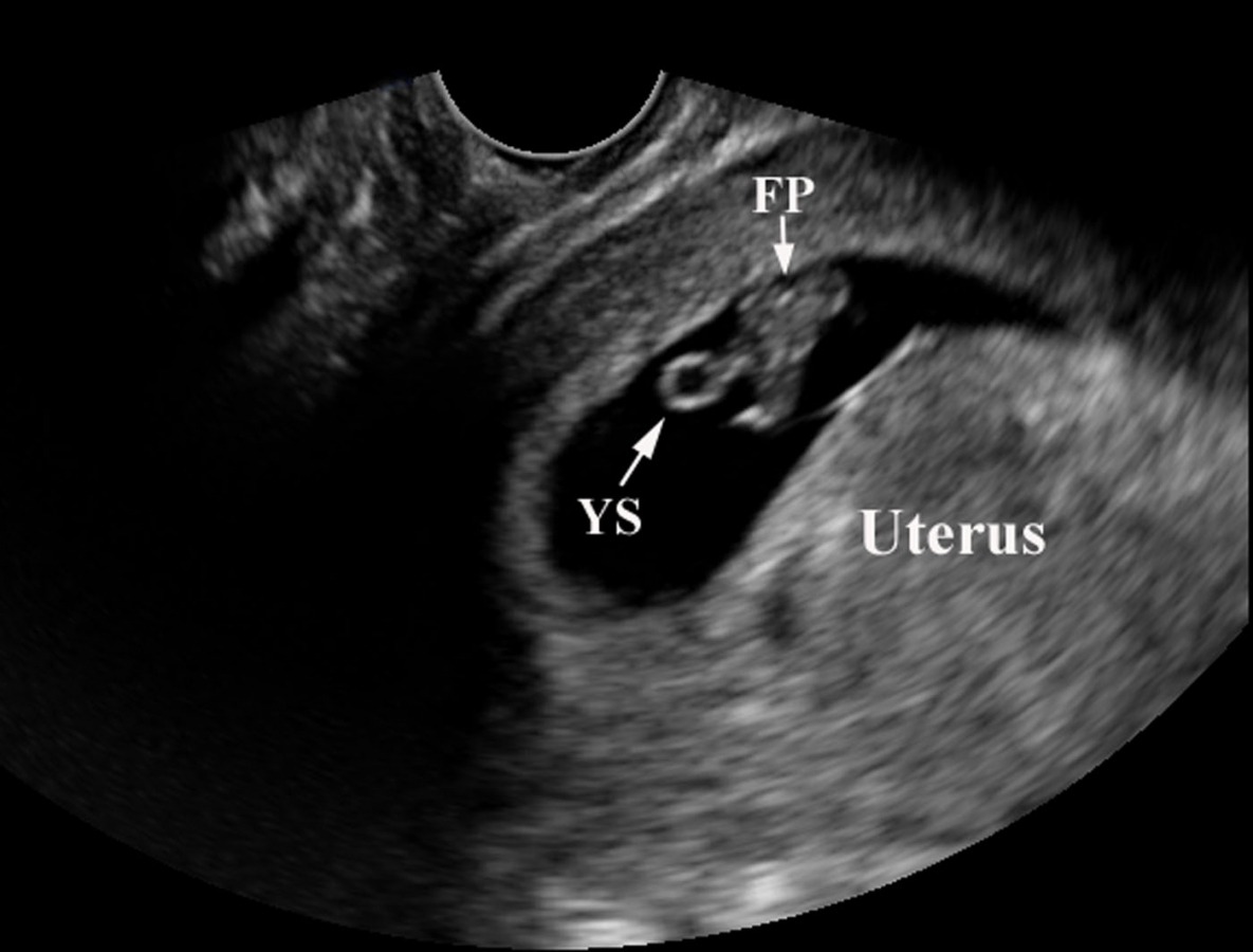 is ultrasound gestational age accurate