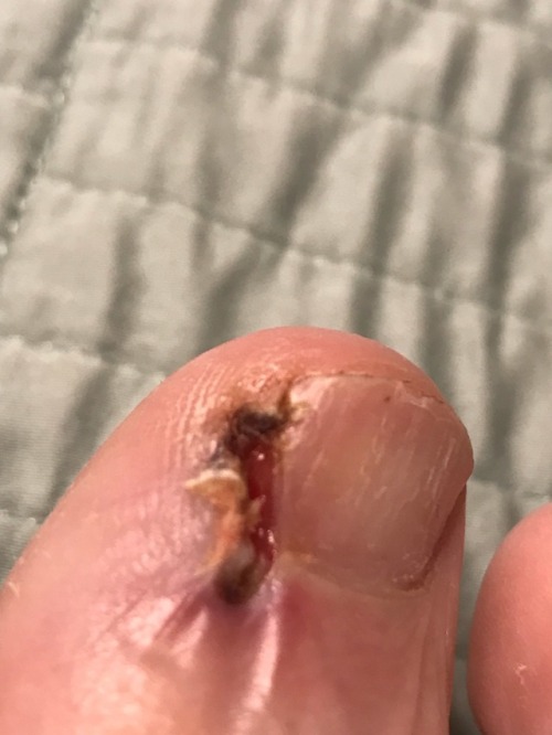 My newest pain…ingrown toenail surgery...