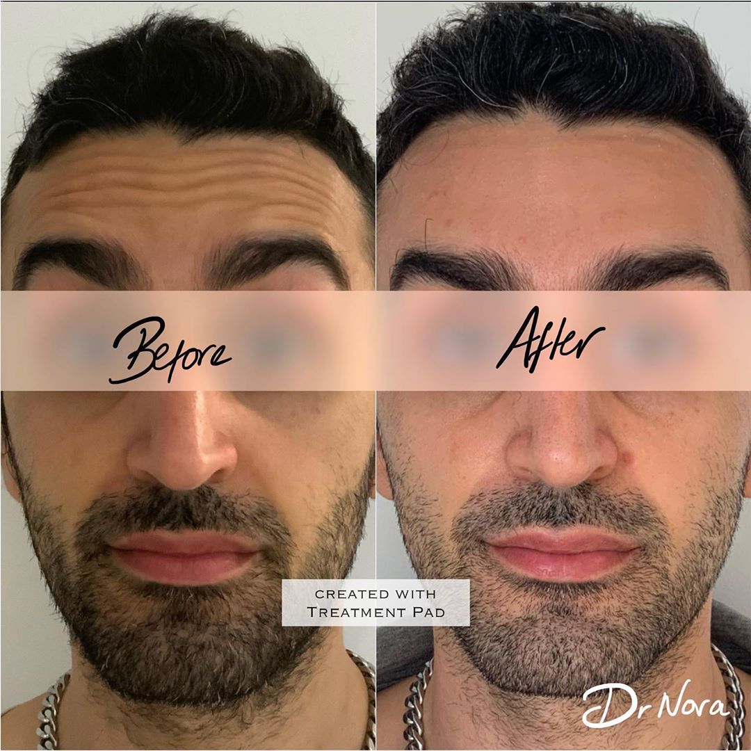 Anti-wrinkle treatment of the forehead 😲Anti-wrinkle therapy is a quick and easy way to reduce the appearance of strong and deep lines. Treatment time is 15 minutes, optimal results are seen at 2 weeks and lasts up to 3-5 months.
If you have any...