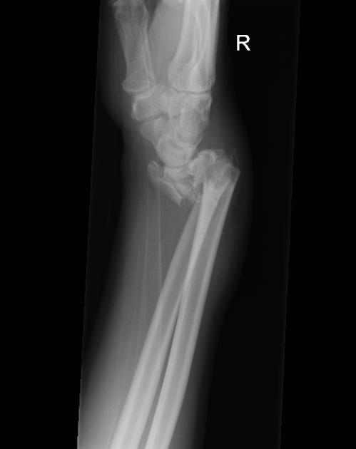 colles smith fracture