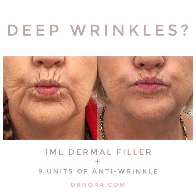 Suffering from deep mouth lines?With the combined use of filler and anti-wrinkle treatment it’s easy to reduce the appearance of lower face lines.
The patient has a noticeable difference in the appearance of her mouth lines after using 1ml of dermal...