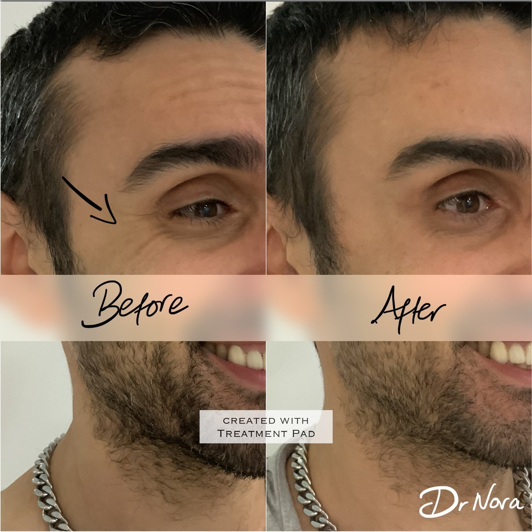 Anti-wrinkle treatment to crows feet π–> πAnti-wrinkle therapy is a quick and easy way to reduce the appearance of strong and deep lines. Treatment time is 15 minutes, optimal results are seen at 2 weeks and lasts up to 3-5 months.
If you have any...