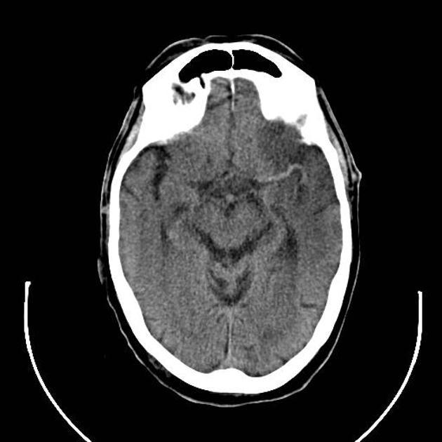 Miscellaneous (Early CT sign in iscehmic stroke They are...)