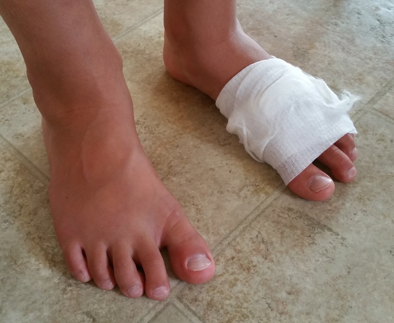 <p><a class="tumblr_blog" href="http://lifeandlimbgel.tumblr.com/post/128941858641">lifeandlimbgel</a>:</p>
<blockquote>
<p><b>Treating Puncture Wounds at Home </b></p>
<p>If you do not have an increased risk of infection, you are free from other injuries, and you do not need a tetanus shot or treatment by a doctor, home treatment can be a safe and effective method at preventing infection and promoting healing.</p>
<p>When treating someone other than yourself, use the American Red Cross’s universal precautions and wear gloves.</p>
<p><b>Remove Foreign Objects</b></p>
<p>First, be sure that the object that caused the wound is not left in the wound. Remove any objects from the wound that you can see. Use tweezers to remove any splinters, or use medical tape by placing tape over the splinter and carefully pulling off the tape. Do not get the splinter wet and take care not to push the object deeper into the wound.</p>
<p><b>Stop Bleeding</b></p>
<p>Apply direct pressure to the wound to stop bleeding. </p>
<p><b>Sterilize the injury</b></p>
<p>As soon as possible, clean the wound to reduce risks of infection or scarring. Using mind soap and cool water, carefully wash the wound for three to five minutes. It is best to avoid harsh products such as alcohol, hydrogen peroxide, or iodine as these products can damage the tissue and slow down healing. Always follow directions for any cleaning products.</p>
<p><b>Assess and Treat the Injury</b></p>
<p>After cleaning the injury, assess the injury and consider your need for medical assistance. If the injury was caused by a dirty or rusty object, a tetanus shot may be required. Unlike a cut, most puncture wounds will most likely heal without stitches, staples, or skin adhesives. If the bleeding cannot be controlled, or if concerns about scarring are present, seek medical assistance. Even though most puncture wounds heal well without a bandage, consider protecting the injury from dirt and irritation. Be sure to clean the wound thoroughly and apply sterile dressings to the wound. </p>
<p><b>After The Injury</b></p>
<p>Pain management with an ice pack or cold pack may reduce swelling and aid in healing. Remember, a barrier should always be used between the cool pack and the skin and ice should never be placed directly on the injured site. Elevate the injury to decrease swelling. Watch for any signs of infection and seek medical attention should warmth and swelling return.</p>
</blockquote>