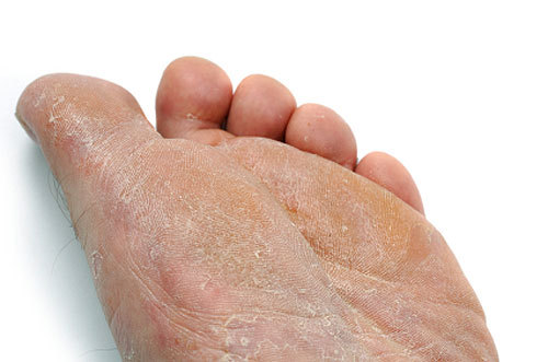 Disease Spotlight of the Week: Athletes’ foot ...