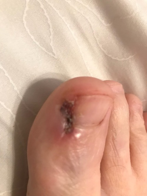 My newest pain…ingrown toenail surgery...