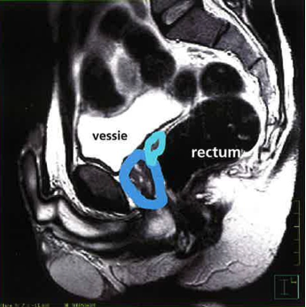 effet secondaires radiothérapie prostate