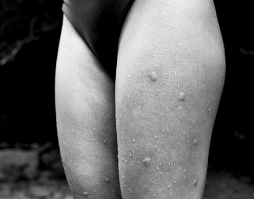 bug bites, 2013