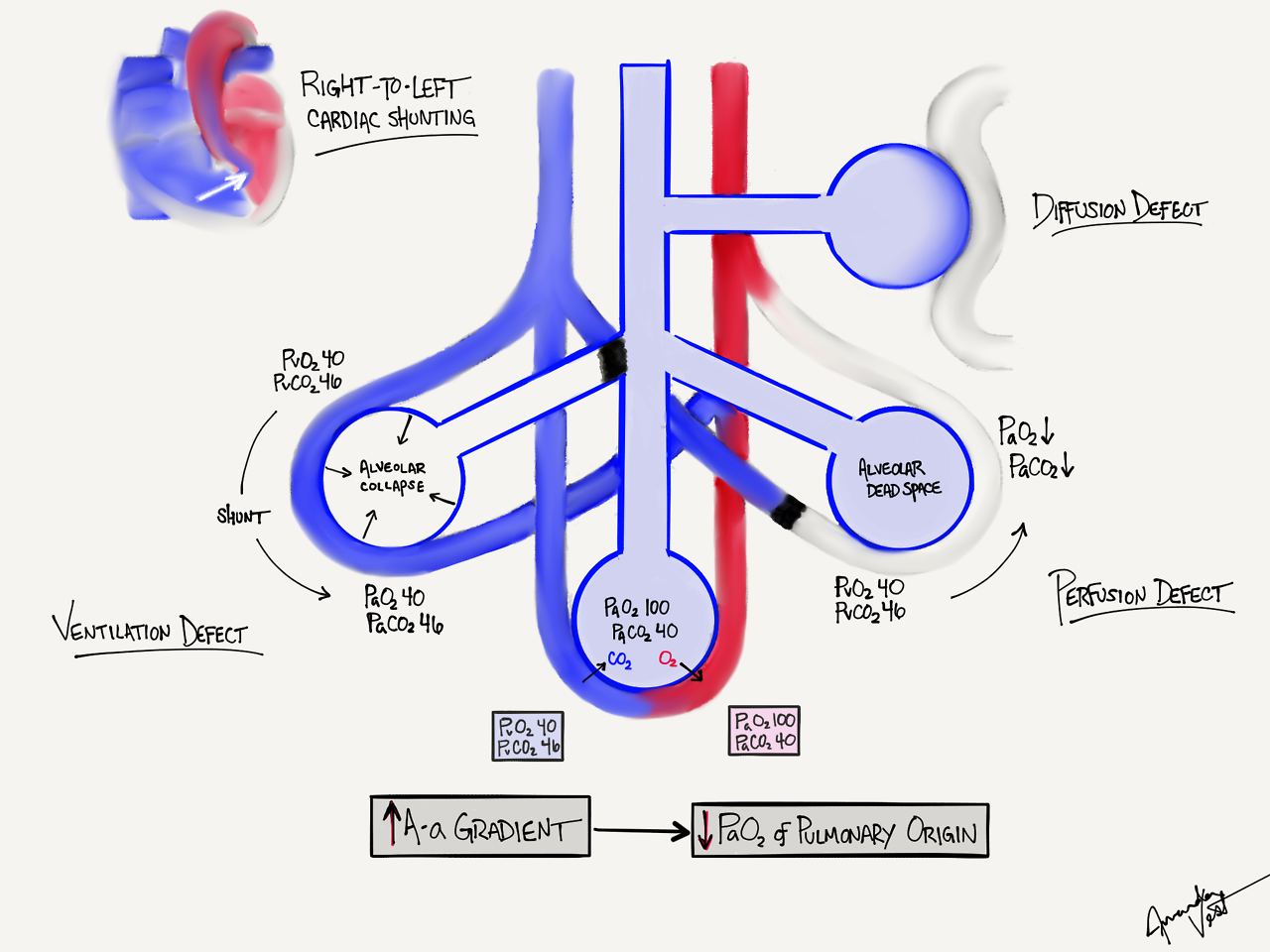 alveolar arterial gradient shunt vs. dead space ventilation