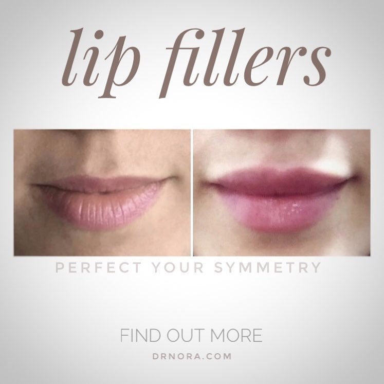 Spot the difference!When placed strategically fillers can change the shape and volume of lips as seen in these gorgeous full voluptuous lipsπ
These lips are definitely ready for the weekend ππ Lip fillers should always be carried out by a qualified...