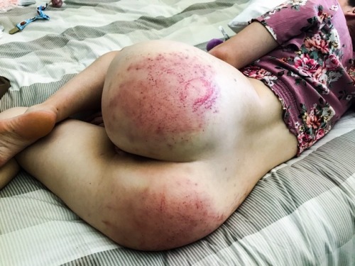 submissivewildling:12 hours post impact and bruises are still...