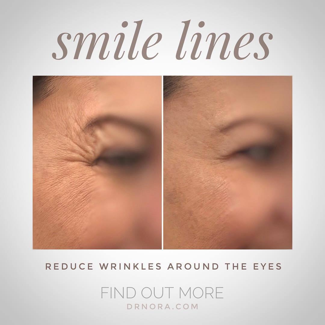 Reduce wrinkles around the eyes πThis lovely lady had a great response from anti-wrinkle treatment. Not only did it help to reduce those deep and soft lines but it’s also helped to open up her eyes, giving a fresher appearance ππ Anti-wrinkle therapy...