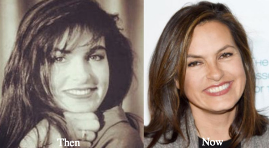 free mariska hargitay plastic surgery