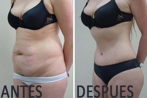 Blog adelgazar antes y despues lipo