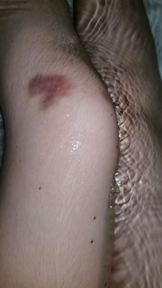 bruise aesthetic on Tumblr