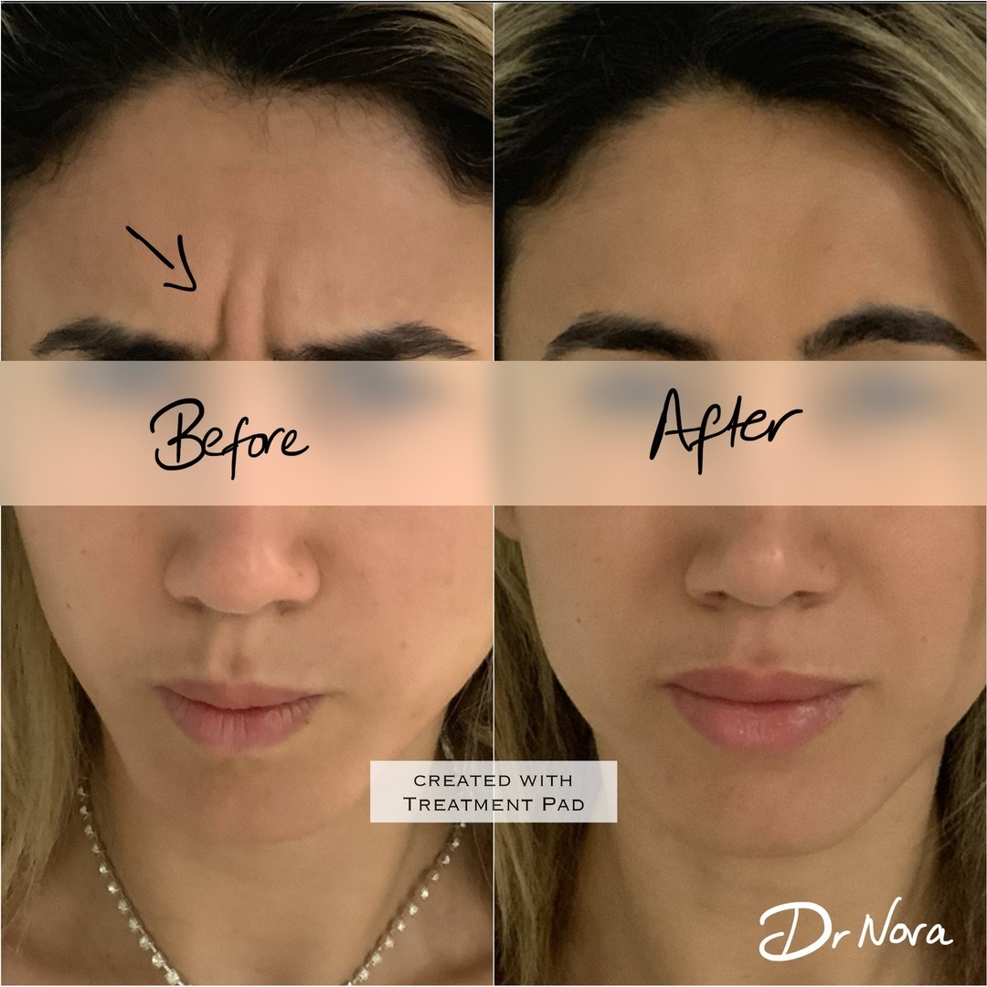 Anti-wrinkle treatment to the frown 😠–>😌 Anti-wrinkle therapy is a quick and easy way to reduce the appearance of strong and deep lines. Treatment time is 15 minutes, optimal results are seen at 2 weeks and lasts up to 3-5 months.If you have any...