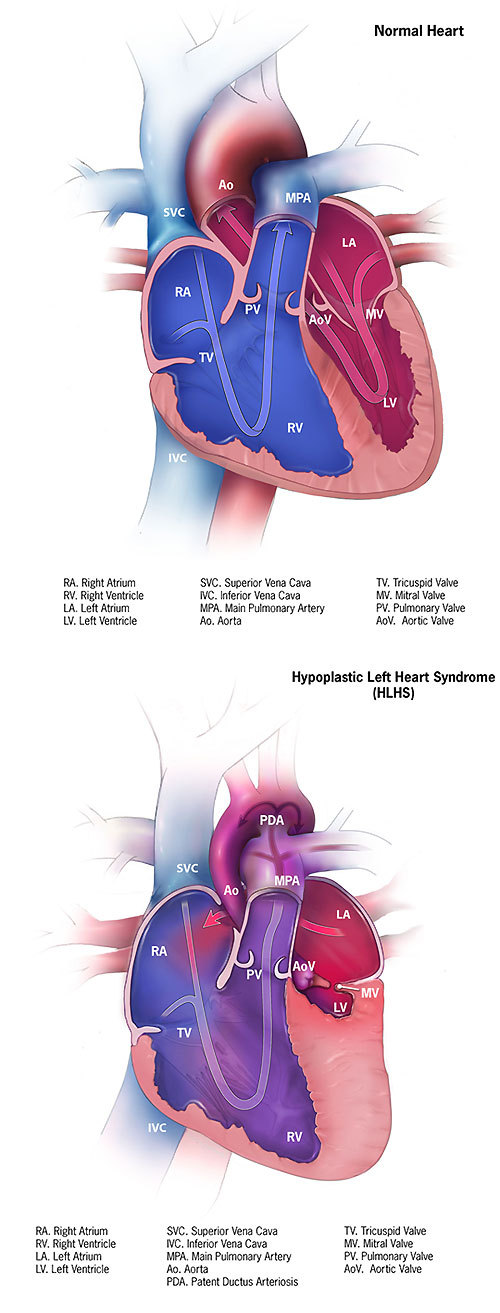 Medical Institution — Hypoplastic left heart syndrome (HLHS) causes ...