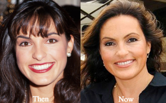 free mariska hargitay plastic surgery