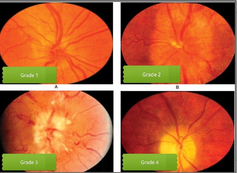 UniMed — Hypertensive Retinopathy Grade I: It consists of...