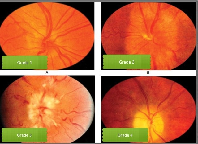 Unimed — Hypertensive Retinopathy Grade I It Consists Of