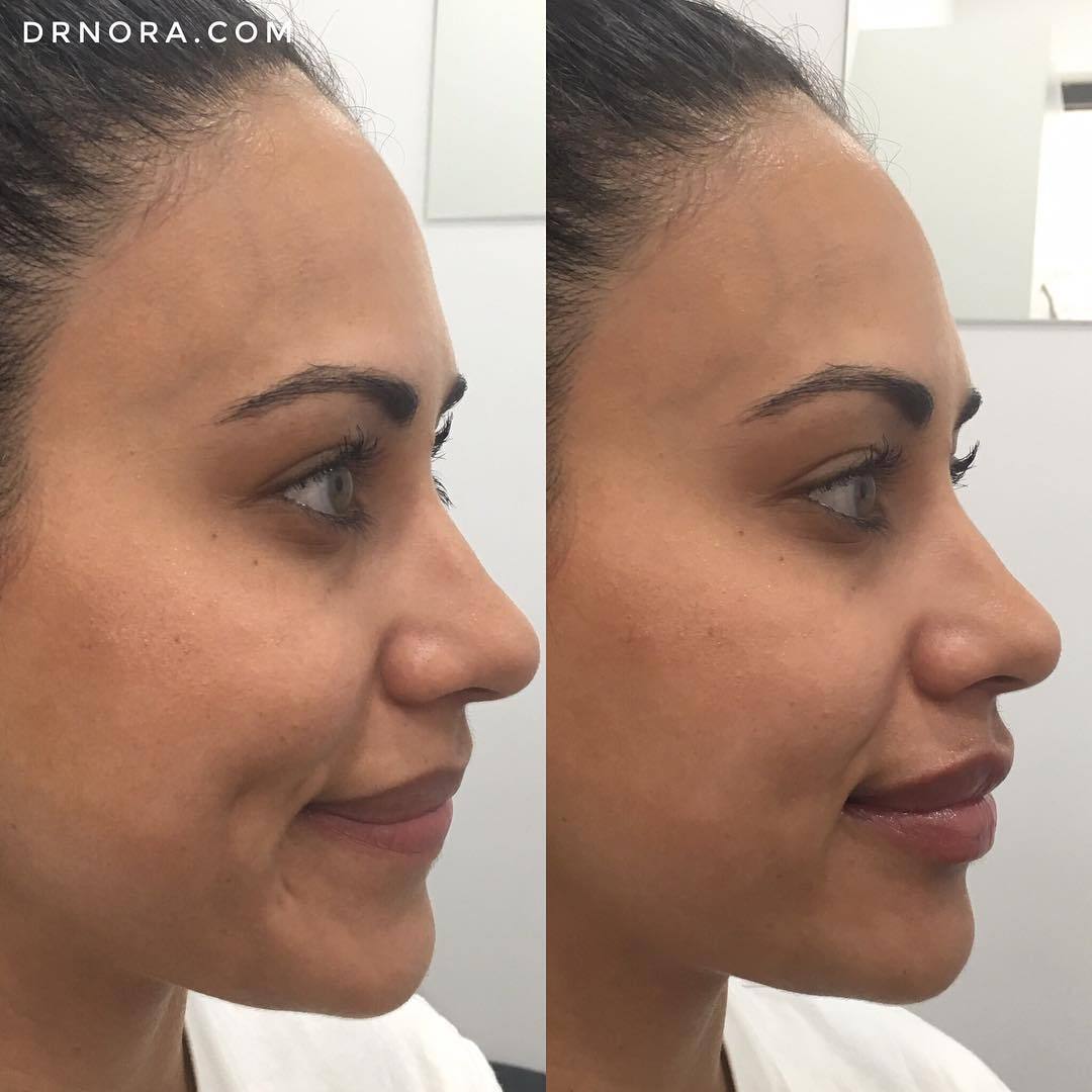 Fresh off the needle 💉This beautiful lady had 1ml of dermal filler in her lips with a fantastic outcome!
Her cupid’s bow is more defined and the lips are more symmetrical, pouty and healthy looking. Kylie Jenner watch out, these lips are gorgeous!...