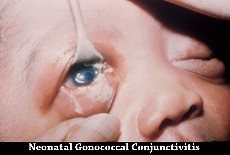 gonorrhea symptoms eye infection