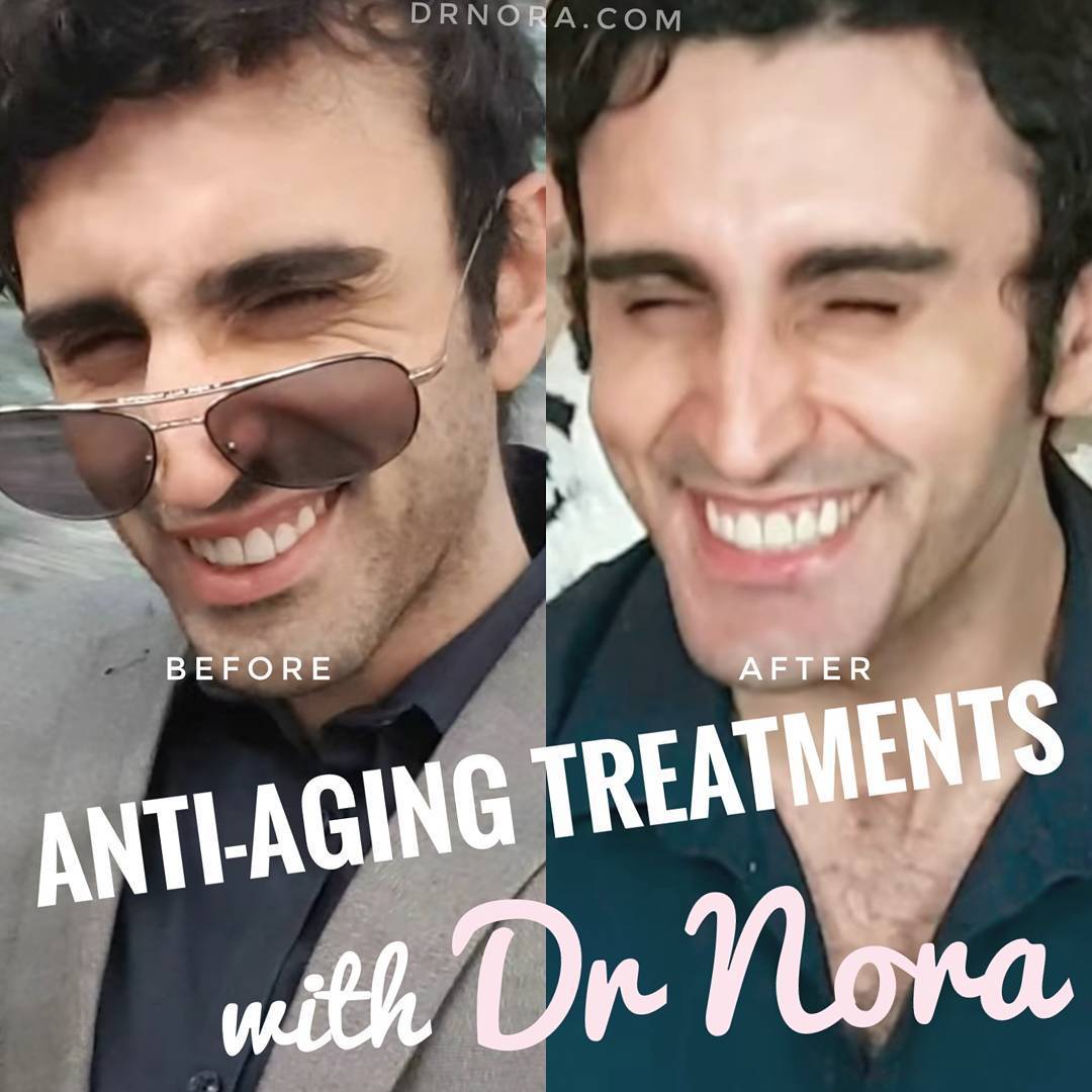 💉 Fantastic anti-wrinkle injection result to treat this patient’s crowsfeet (eye wrinkles). If you have any questions leave a comment below or drop by my website: drnora.comSource: https://instagram.com/p/BY-LRpRjOkL/
