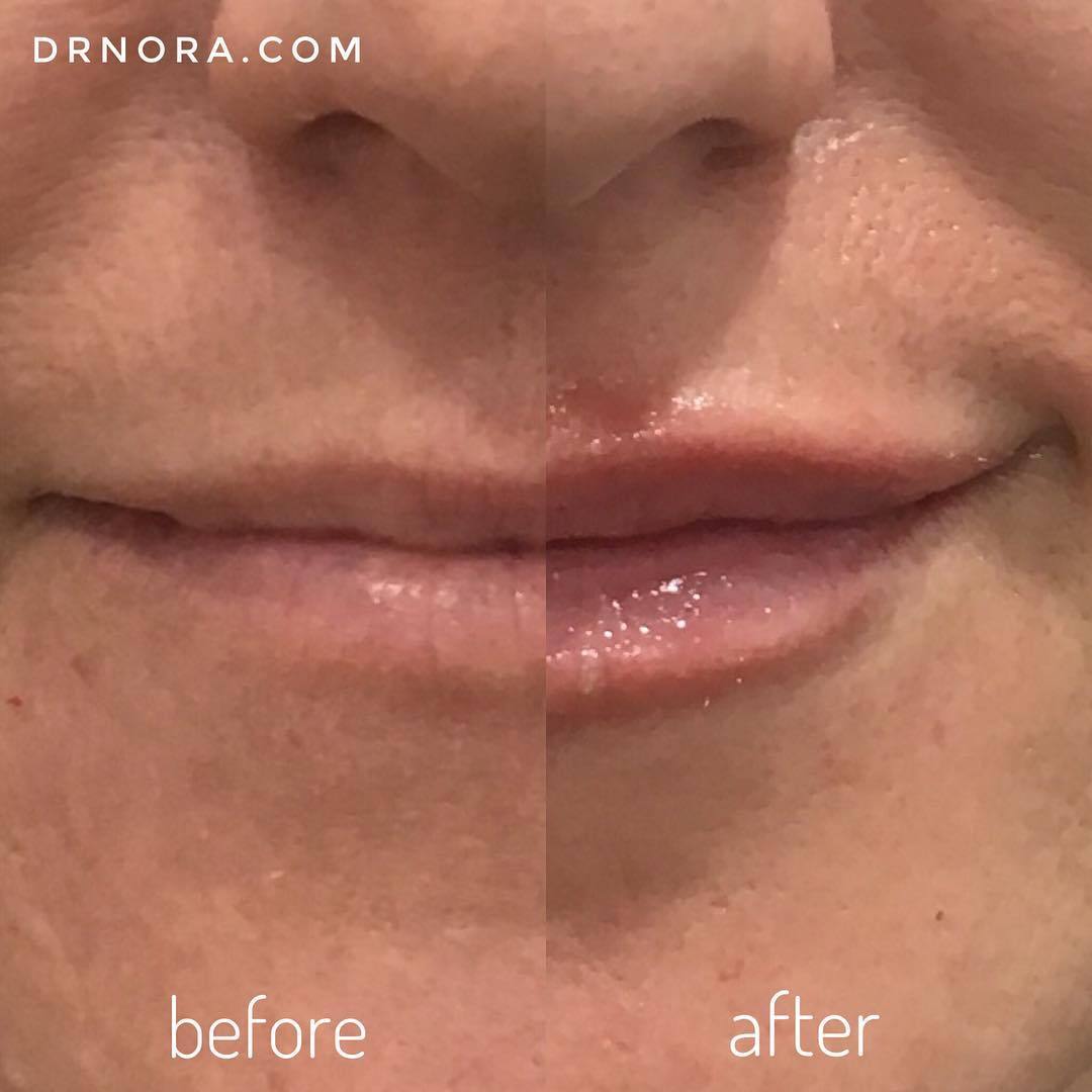 A little can go a long way! ππ These gorgeous lips had 0.7ml of lip filler and the result is fantastic! They look instantly hydrated and plumped up! Our first-time patient was nervous about using the full 1ml, so we’ve kept some reserved for next...