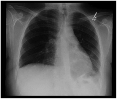 normal-chest-x-ray-18-months-post-repair