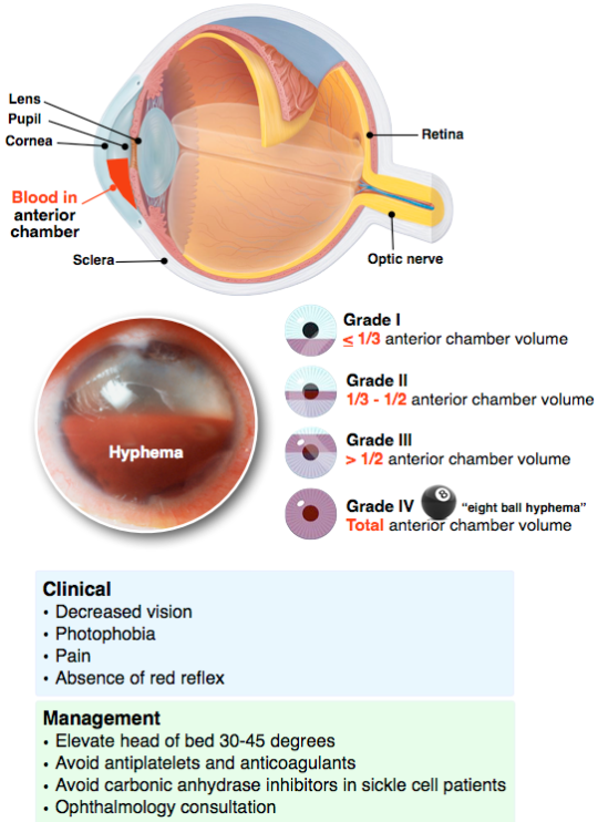 hyphema on Tumblr