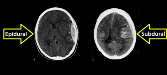 In Case I Forget: Epidural vs Subdural Hematoma | the little one