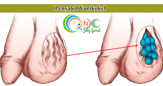 Cara Mengobati Varikokel Tanpa Operasi