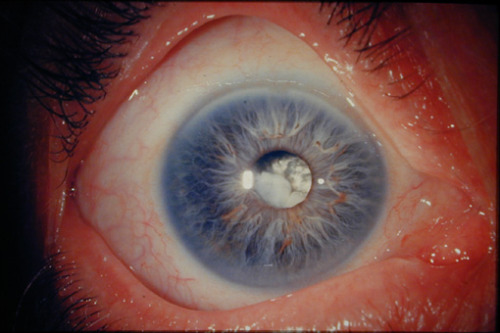 eyedefects:Subluxated cataract in vitreous cavity