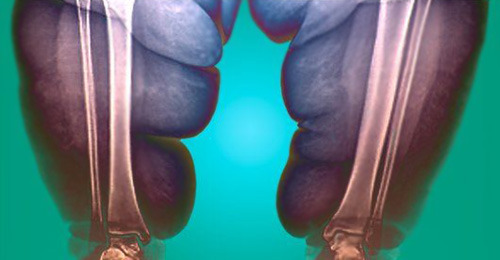 X-ray of an obese person’s legs (source: galloimages)