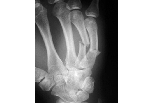 5th metacarpal fracture healing time