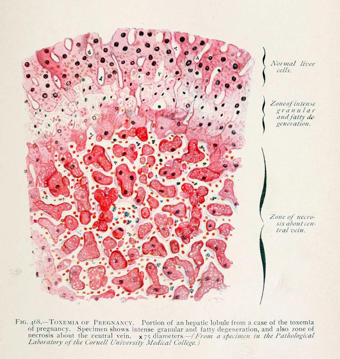 toxemia-of-pregnancy-this-liver-damage-caused-by-biomedical