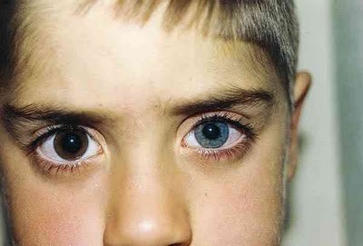 condition of unequal pupil size