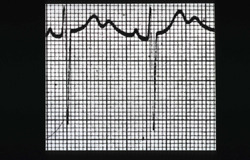 USMLE Pathology Slides - EKG with U waves in a patient with hypokalemia...