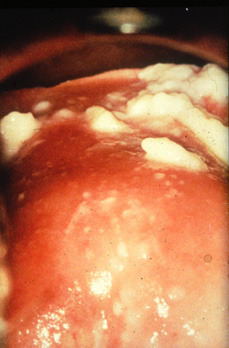 Usmle Pathology Slides Cottage Cheese Discharge Of Vaginal