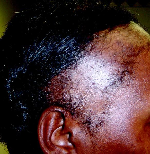 Essentious Natural Remedies For Balding Thinning Edges