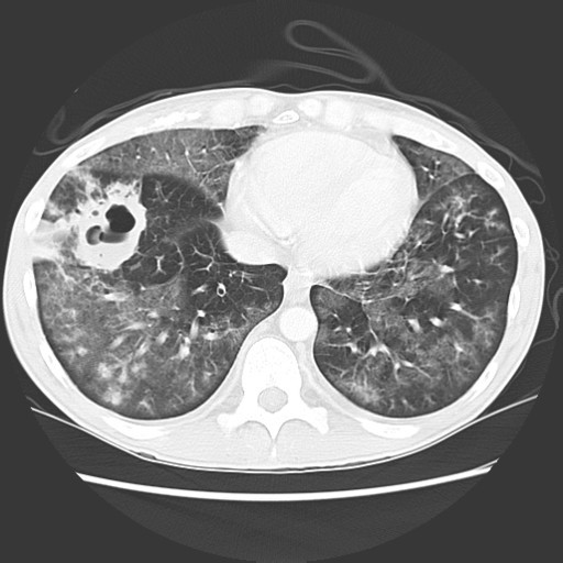 CluelessMedic — Pneumocystis Pneumonia: Caused by fungal organism...